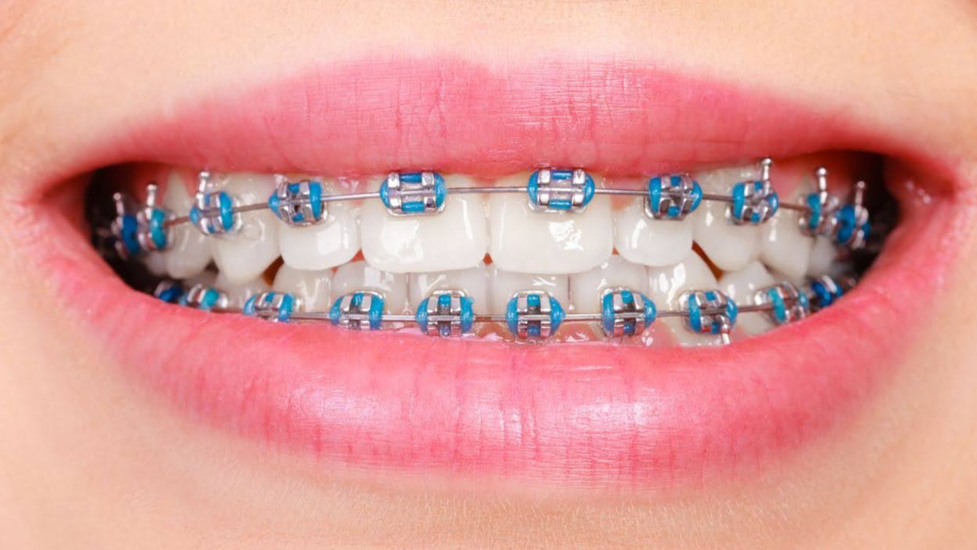 braces